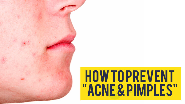 How to prevent Acne & Pimples Recipe | Masala TV